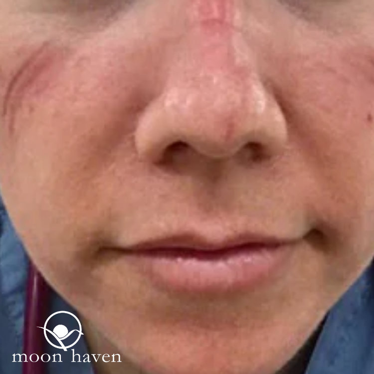 Mask Rash and Irritation - What helps?