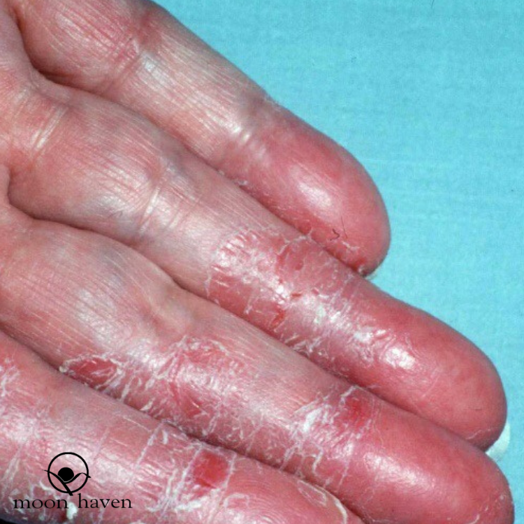 Irritant Contact Dermatitis OR Don’t Use A Body Wash If You Have Sensitive Skin