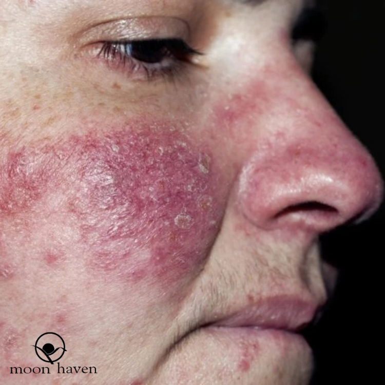 Is it really Acne? or could it be Papulopustular or Inflammatory Rosacea?