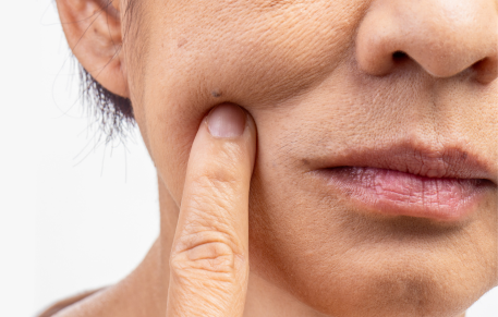 Dry Skin & How To Care For It