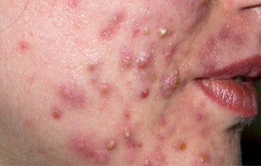 Moon Haven guide to treating adult acne naturally