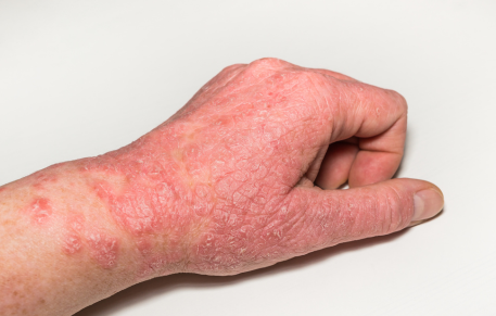 Irritant Contact Dermatitis OR Don’t Use A Body Wash If You Have Sensitive Skin