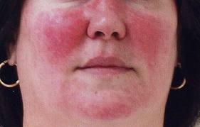 Red Faced… Are You Permanently Embarrassed or is it Rosacea?